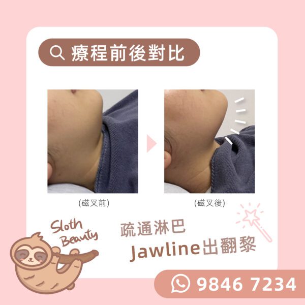 【去水腫】淋巴引流磁叉 Facial - Image 3